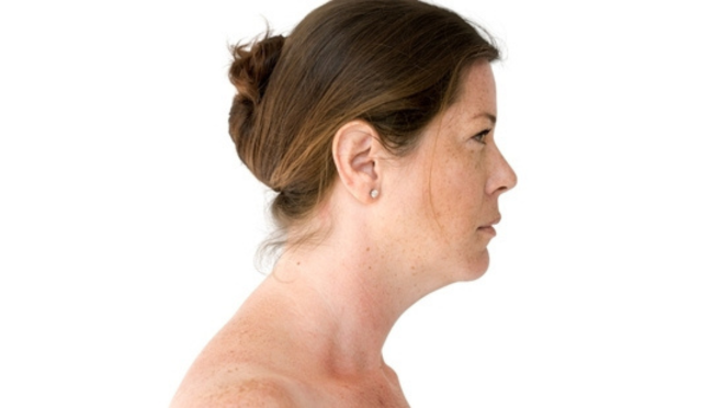 neck hump