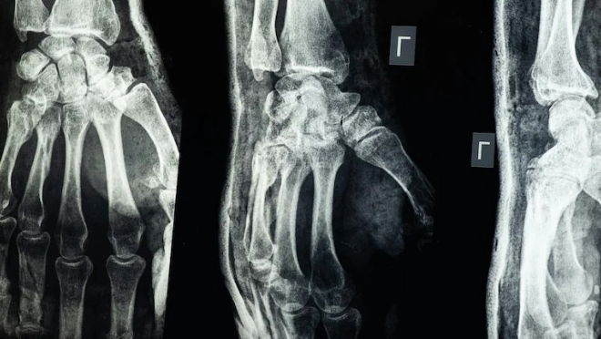 bone