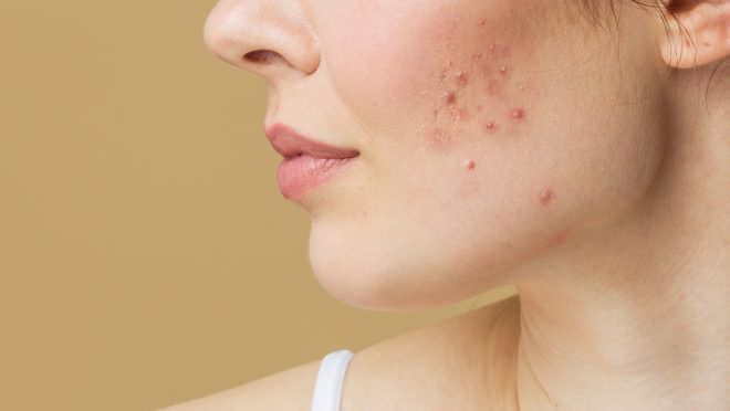 Young woman before and after acne treatment. Skin care concept